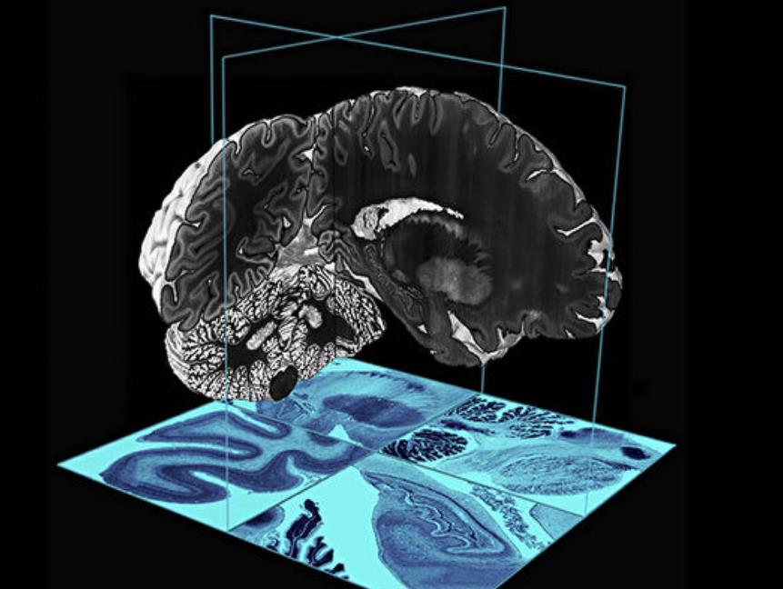 無創植入大腦芯片或能成為現實